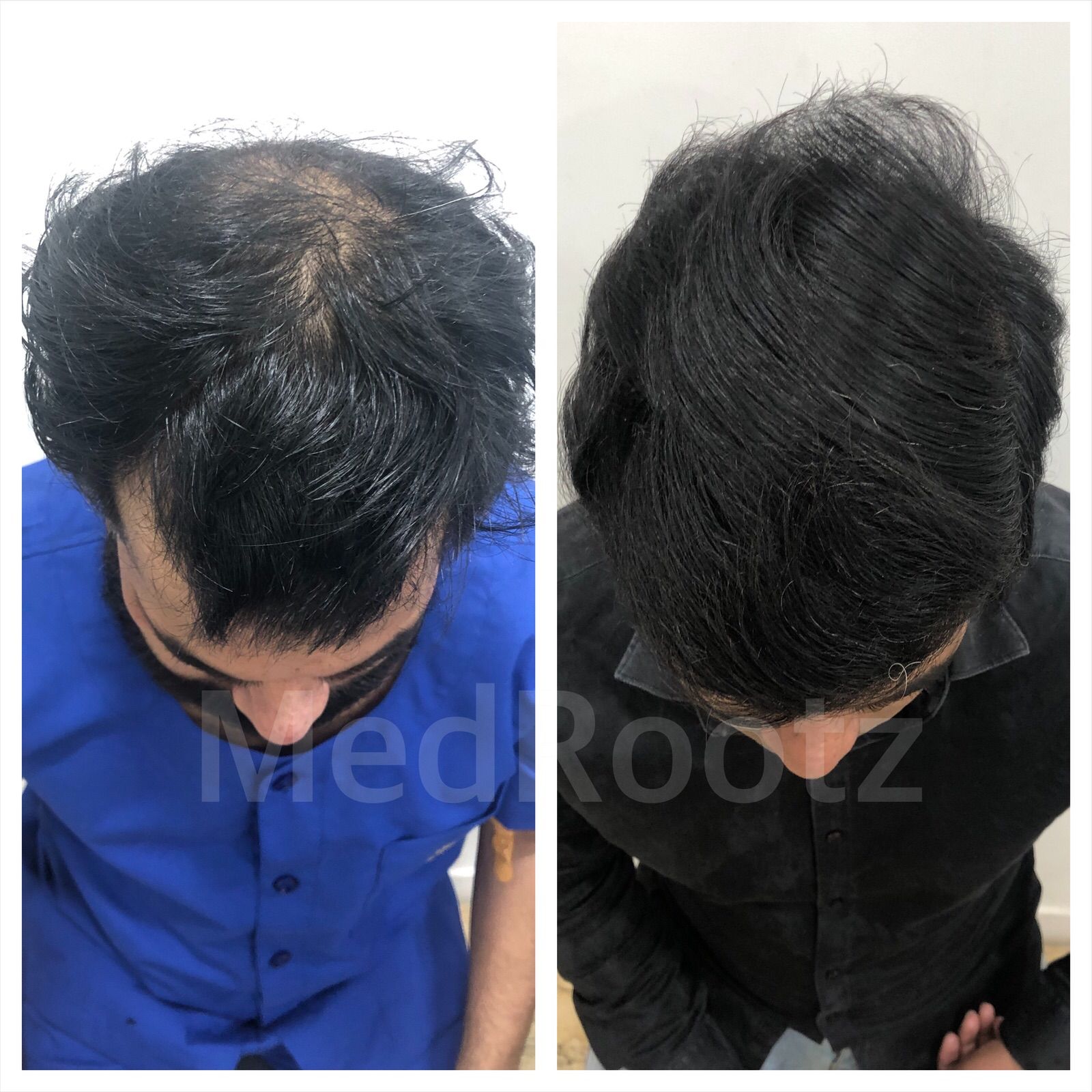 Best Hair Transplant clinic in delhi